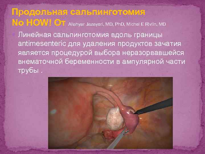 Продольная сальпинготомия No HOW! От Allahyar Jazayeri, MD, Ph. D, Michel E Rivlin, MD