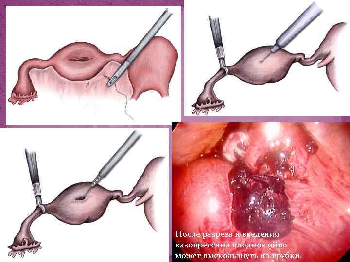 После разреза и введения вазопрессина плодное яйцо может выскользнуть из трубки. 