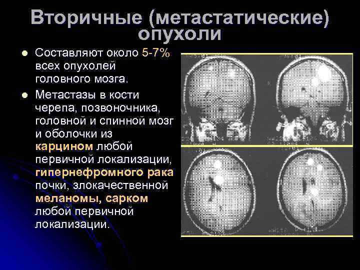 Метастазы в мозг прогноз. Первичные и вторичные опухоли головного мозга. Метастатические опухоли головного мозга. Вторичные новообразования головного мозга.