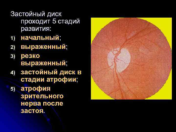 Застойный диск проходит 5 стадий развития: 1) начальный; 2) выраженный; 3) резко выраженный; 4)