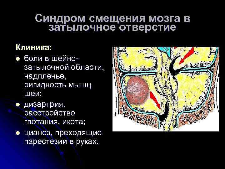 Синдром смещения мозга в затылочное отверстие Клиника: l боли в шейнозатылочной области, надплечье, ригидность