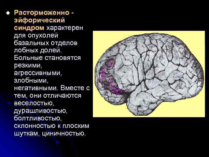 l Расторможенно эйфорический синдром характерен для опухолей базальных отделов лобных долей. Больные становятся резкими,