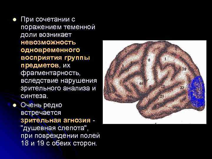 l l При сочетании с поражением теменной доли возникает невозможность одновременного восприятия группы предметов,