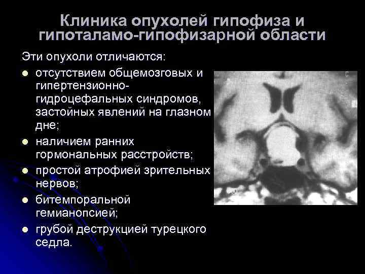 Клиника опухолей гипофиза и гипоталамо-гипофизарной области Эти опухоли отличаются: l отсутствием общемозговых и гипертензионногидроцефальных