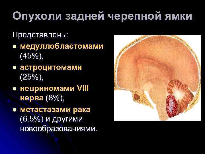 Опухоли задней черепной ямки Представлены: l медуллобластомами (45%), l астроцитомами (25%), l невриномами VIII