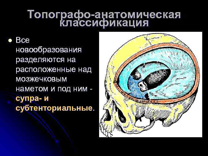 Топографо-анатомическая классификация l Все новообразования разделяются на расположенные над мозжечковым наметом и под ним