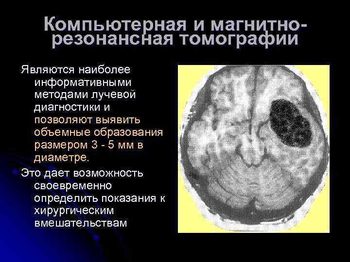 Компьютерная и магнитнорезонансная томографии Являются наиболее информативными методами лучевой диагностики и позволяют выявить объемные