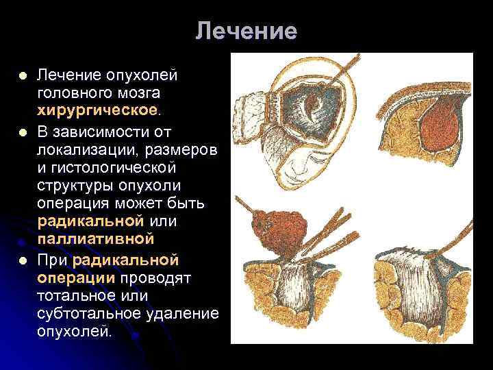 Лечение l l l Лечение опухолей головного мозга хирургическое. В зависимости от локализации, размеров