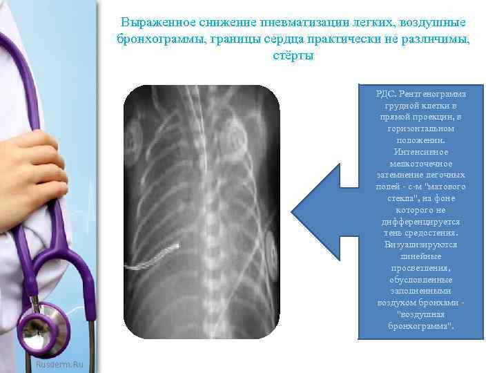 Выраженное снижение пневматизации легких, воздушные бронхограммы, границы сердца практически не различимы, стёрты РДС. Рентгенограмма