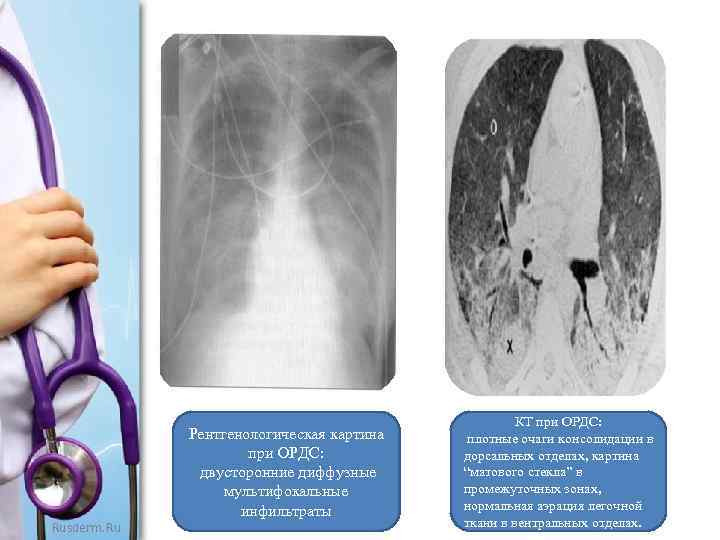 Рентгенологическая картина при ОРДС: двусторонние диффузные мультифокальные инфильтраты Rusderm. Ru КТ при ОРДС: плотные