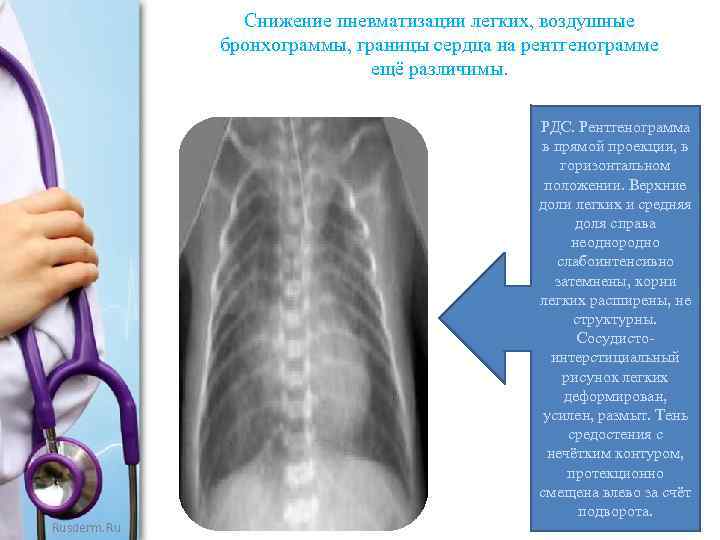 Снижение пневматизации легких, воздушные бронхограммы, границы сердца на рентгенограмме ещё различимы. Rusderm. Ru РДС.