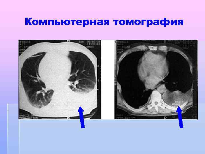 Компьютерная томография 