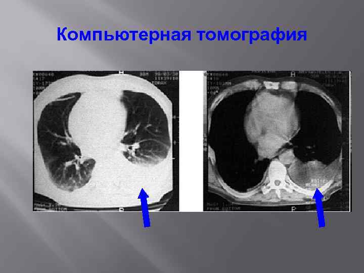 Компьютерная томография 