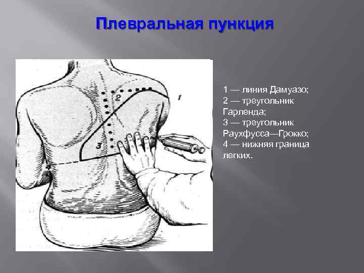 Плевральная пункция 1 — линия Дамуазо; 2 — треугольник Гарленда; 3 — треугольник Раухфусса—Грокко;