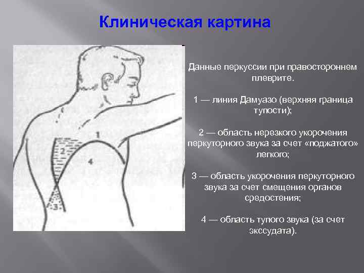 Клиническая картина Данные перкуссии правостороннем плеврите. 1 — линия Дамуазо (верхняя граница тупости); 2