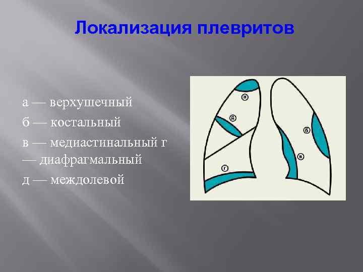 Локализация плевритов а — верхушечный б — костальный в — медиастинальный г — диафрагмальный