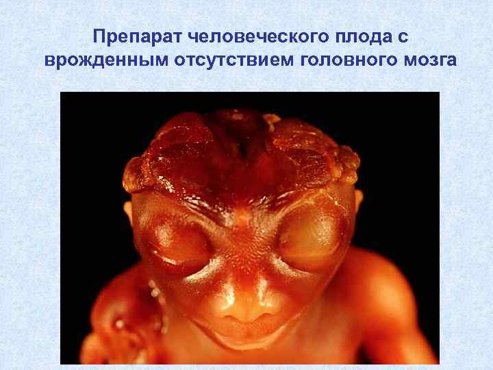  Препарат человеческого плода с врожденным отсутствием головного мозга 
