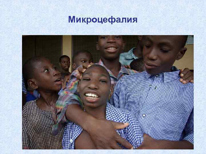 Микроцефалия 