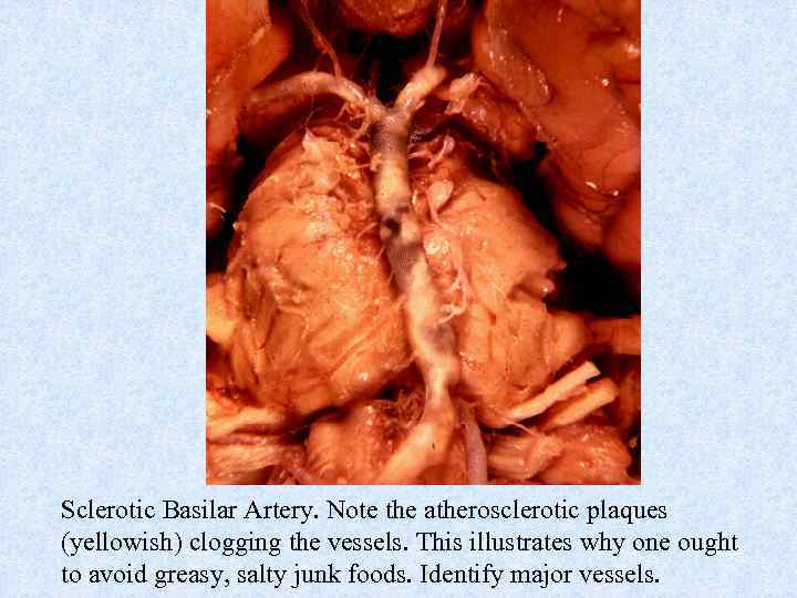 Sclerotic Basilar Artery. Note the atherosclerotic plaques (yellowish) clogging the vessels. This illustrates why