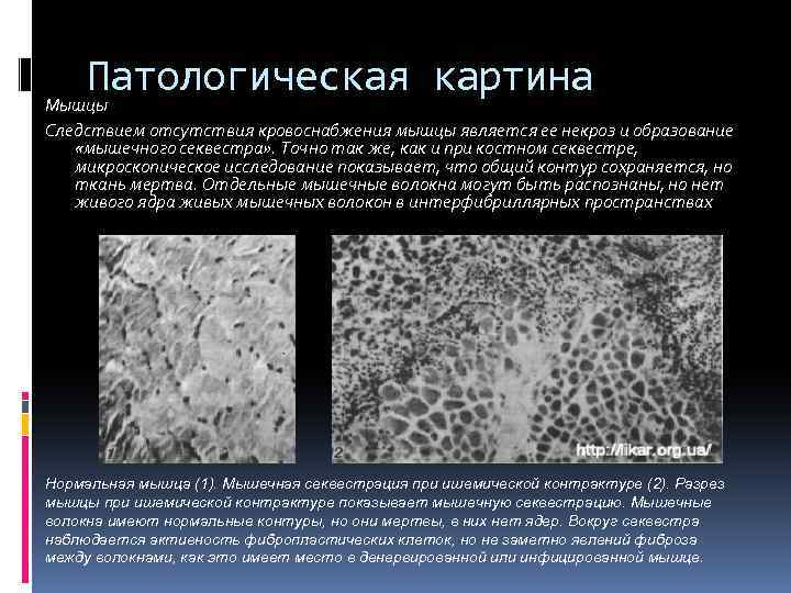 Патологическая картина Мышцы Следствием отсутствия кровоснабжения мышцы является ее некроз и образование «мышечного секвестра»