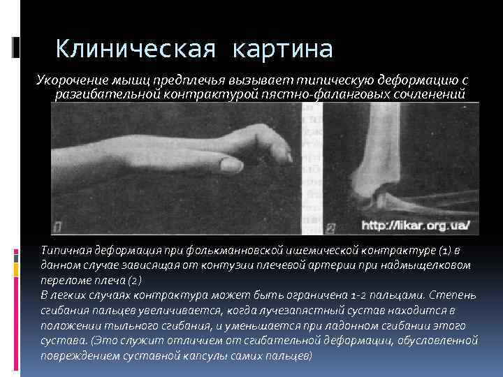Клиническая картина Укорочение мышц предплечья вызывает типическую деформацию с разгибательной контрактурой пястно-фаланговых сочленений Типичная