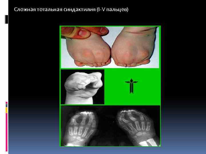 Сложная тотальная синдактилия (I-V пальцев) 