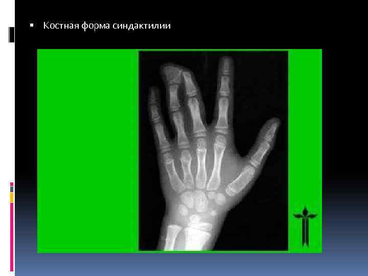  Костная форма синдактилии 