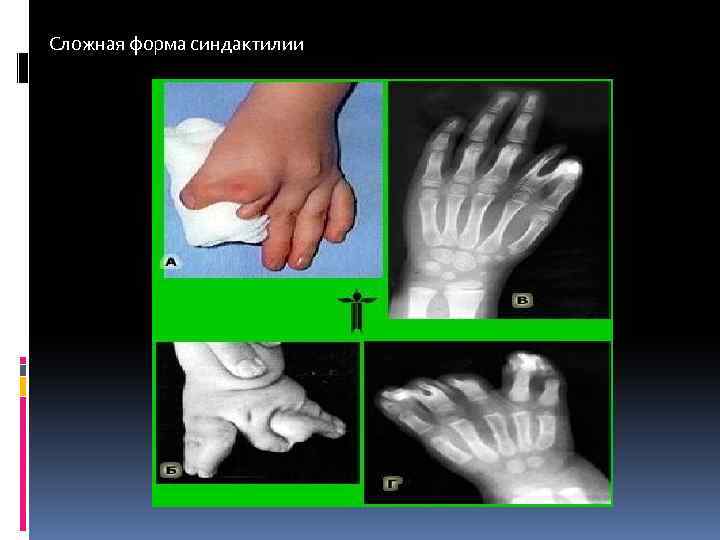 Сложная форма синдактилии 