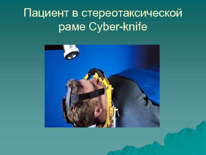 Пациент в стереотаксической раме Cyber-knife 