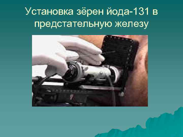 Установка зёрен йода-131 в предстательную железу 