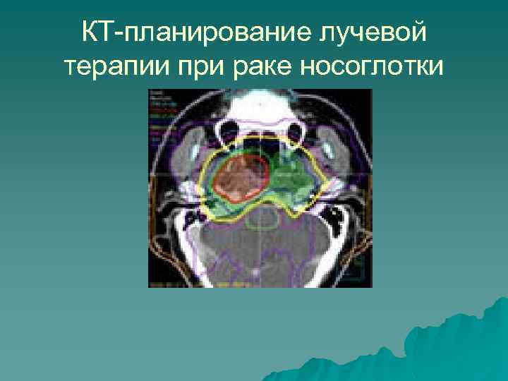 КТ-планирование лучевой терапии при раке носоглотки 