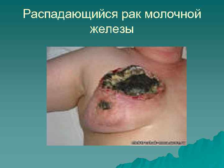 Распадающийся рак молочной железы 