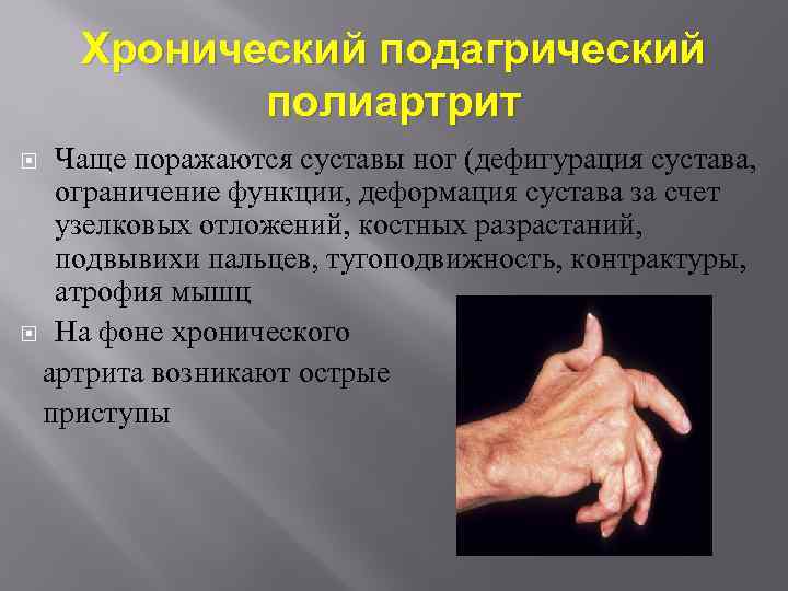 Хронический подагрический полиартрит Чаще поражаются суставы ног (дефигурация сустава, ограничение функции, деформация сустава за