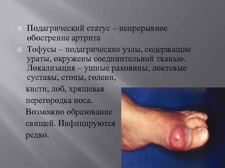  Подагрический статус – непрерывное обострение артрита Тофусы – подагрические узлы, содержащие ураты, окружены
