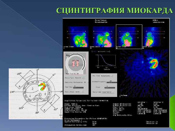 СЦИНТИГРАФИЯ МИОКАРДА 