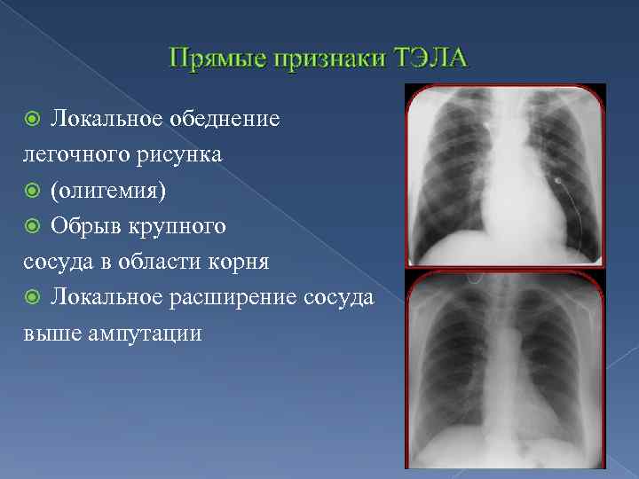 Обеднение сосудистого рисунка