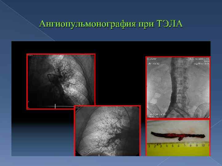 Ангиопульмонография при ТЭЛА 