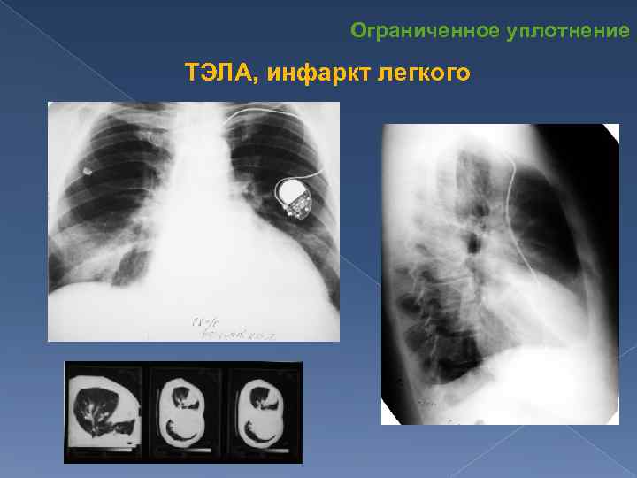 Ограниченное уплотнение ТЭЛА, инфаркт легкого 