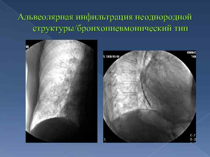 Альвеолярная инфильтрация неоднородной структуры/бронхопневмонический тип 