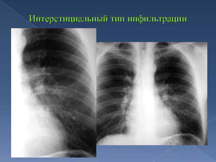 Интерстициальный тип инфильтрации 
