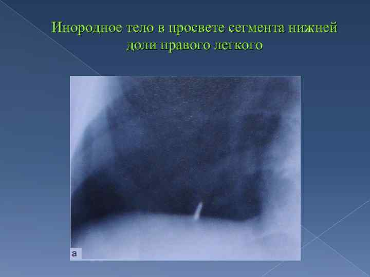 Инородное тело в просвете сегмента нижней доли правого легкого 