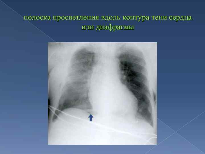 полоска просветления вдоль контура тени сердца или диафрагмы 