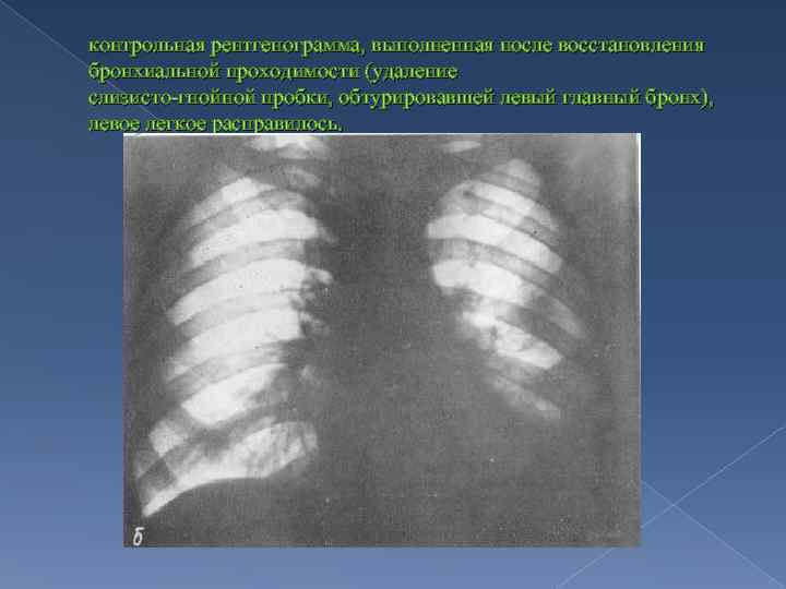 контрольная рентгенограмма, выполненная после восстановления бронхиальной проходимости (удаление слизисто-гнойной пробки, обтурировавшей левый главный бронх),