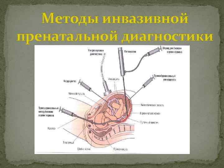 Методы инвазивной пренатальной диагностики 