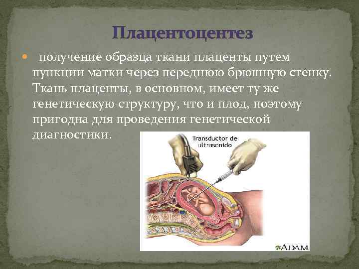 Плацентоцентез получение образца ткани плаценты путем пункции матки через переднюю брюшную стенку. Ткань плаценты,