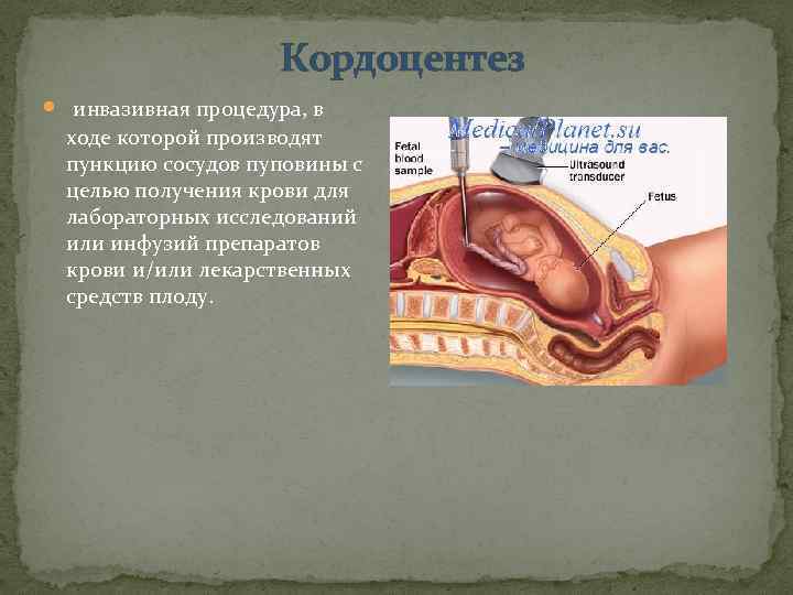 Кордоцентез инвазивная процедура, в ходе которой производят пункцию сосудов пуповины с целью получения крови