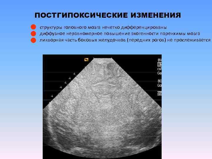 ПОСТГИПОКСИЧЕСКИЕ ИЗМЕНЕНИЯ структуры головного мозга нечетко дифференцированы диффузное неравномерное повышение эхогенности паренхимы мозга ликворная