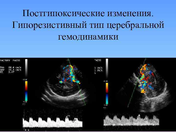 Постгипоксические изменения. Гипорезистивный тип церебральной гемодинамики 