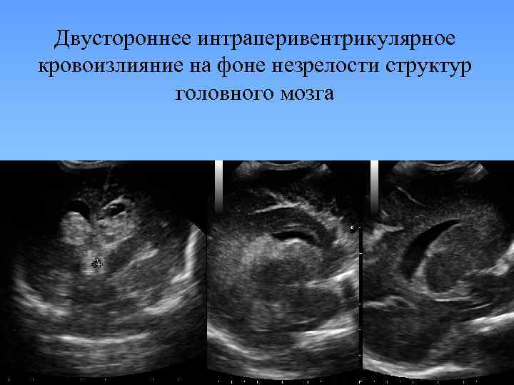 Двустороннее интраперивентрикулярное кровоизлияние на фоне незрелости структур головного мозга 