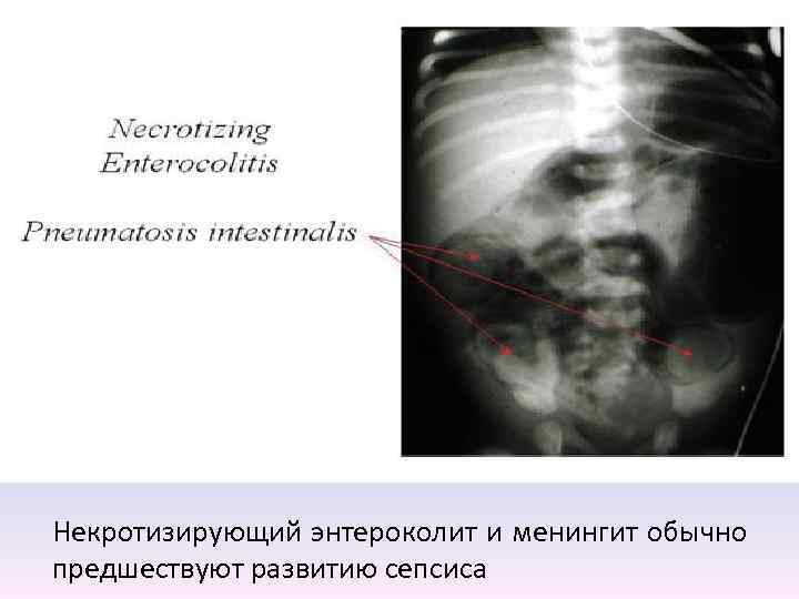 Некротизирующий энтероколит и менингит обычно предшествуют развитию сепсиса 